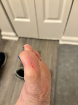 Callus remover cuts