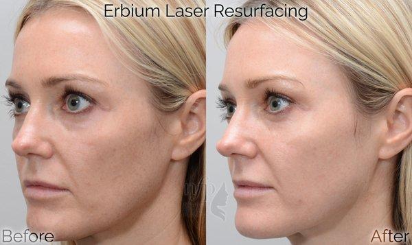 Fractional Erbium Laser Skin Resurfacing works great to treat sun damage, and in combination with optimal skin care, gives optimal results!