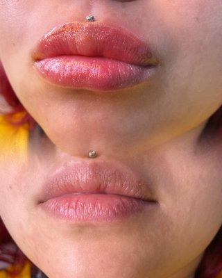 1ML hyaluron lip filler 
 Immediately after 
 (No needle, no pain, instant results)