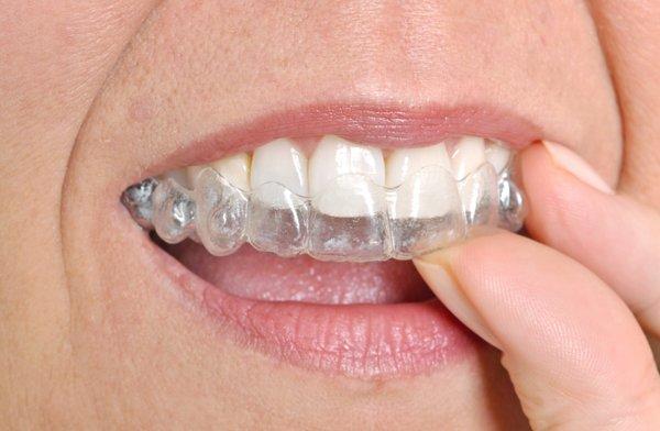 Clear Aligners