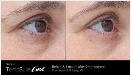 Reducing the appearance of wrinkles and lines