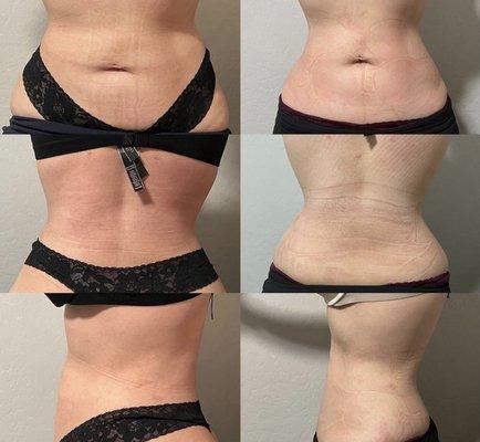 Treatments include wood therapy, noninvasive laser lipo, ultrasound cavitation, and radiofrequency.