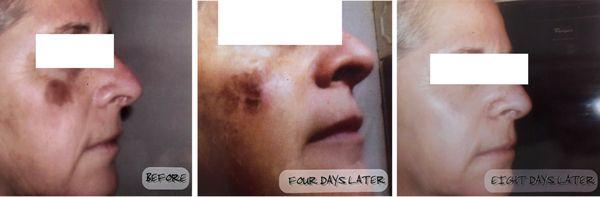 Scar and mole treatment