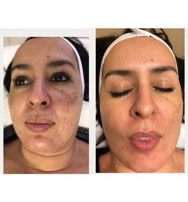 Before and after ONE month of microneedling. Amazing results!