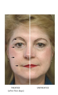 Micro-current non invasive facelift. Before/after picture