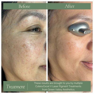 Sun damage/ age spot reduction for our happy client