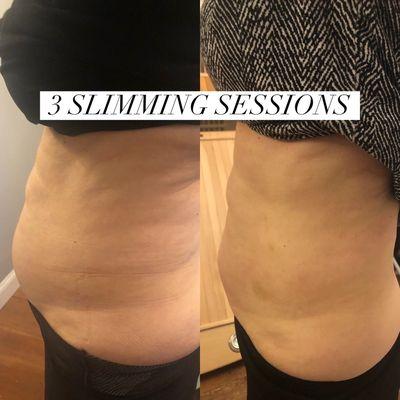 Cryotherapy slimming