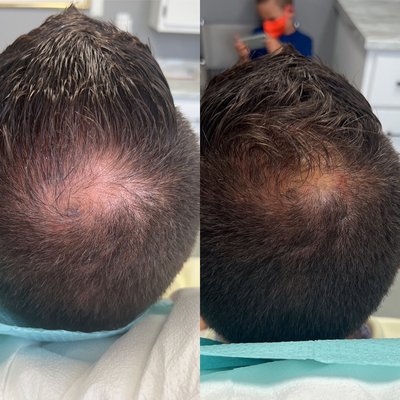 PRP for hair loss