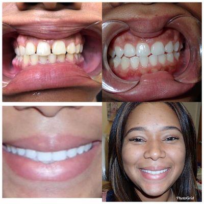 Before & After Invisalign