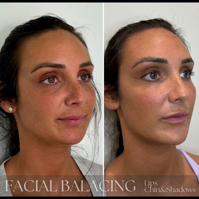 Facial Balancing Treatment, Lip filler and Chin Filler in Phoenixville, PA at Nakd Aesthetics.