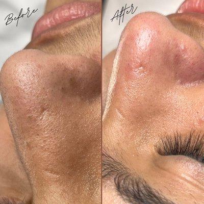 Deep Pore Facial with extractions