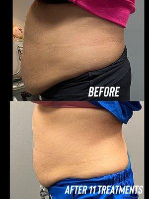 Result of 11 CryoSlimming Treatments