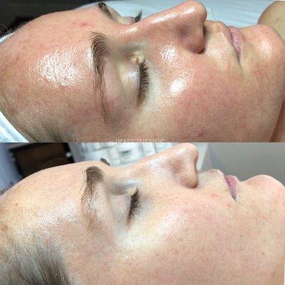 Before and after of inflammation and acne correction happening