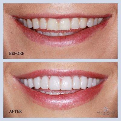 Before and After Porcelain Veneers