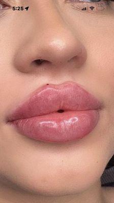 Russian Babe lips. 4-5 sessions typically, clients outcome can vary.