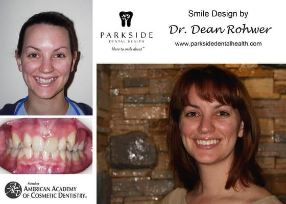 Dr. Rohwer can do traditional orthodontic cases like he did for this patient. What a difference a smile can make in life.