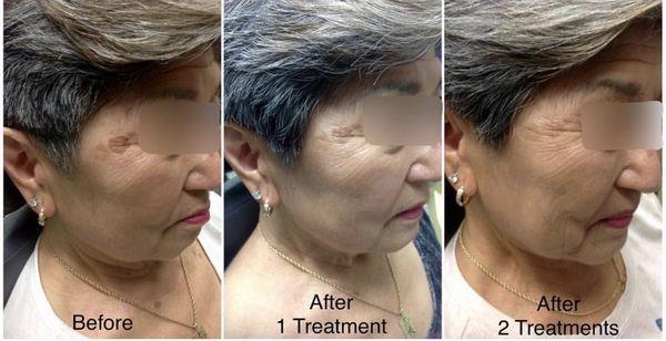 Dark spot reduction