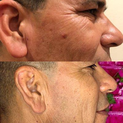 Plasma Fibroblast Skintightening for crows feet