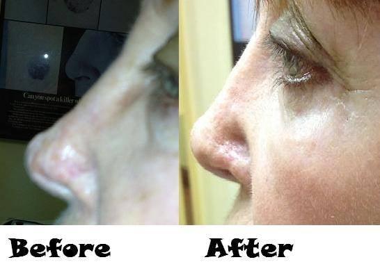 You no longer have to suffer from disfiguring surgical scars from cancer, accidents, or any other reasons