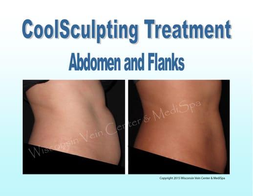 Having the CoolSculpting® treatment results in noticeable, natural-looking fat reduction in
 the treated areas.