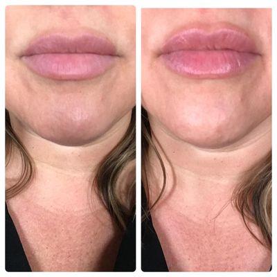 Lip plumping treatment