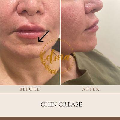 Treatment of chin crease with dermal filler injections