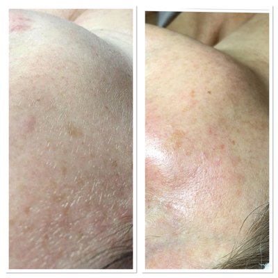 Dermaplaning treatment