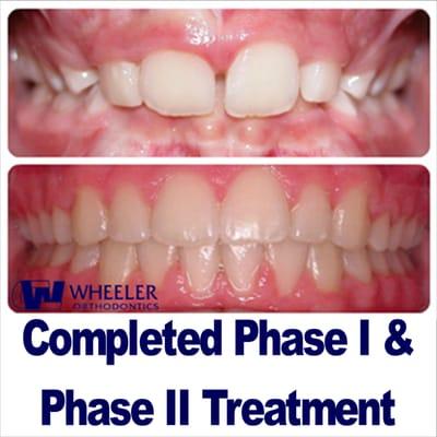 Actual case treated at Wheeler Orthodontics.