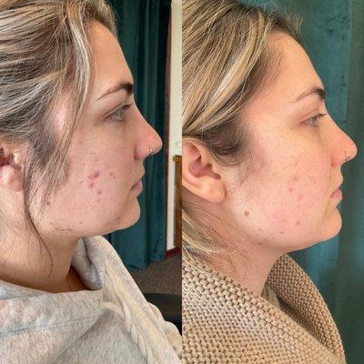 Acne scarring improvement