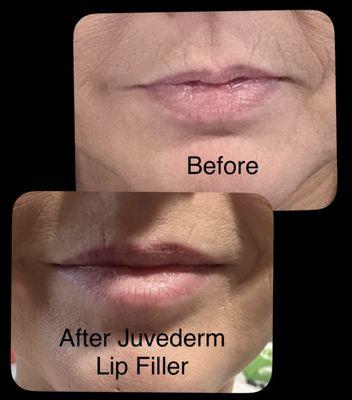 Juvederm Lip filler to create symmetry in lips.