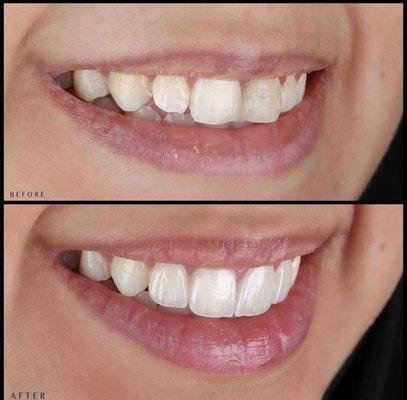 Before & After - Cosmetic veneers