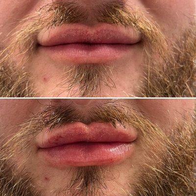 Revanesse lips dermal filler.