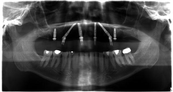 An X-ray of implants on the upper jaw to replace all the upper teeth.