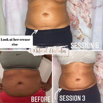 Ultrasound Cavitation + Fat Dissolve