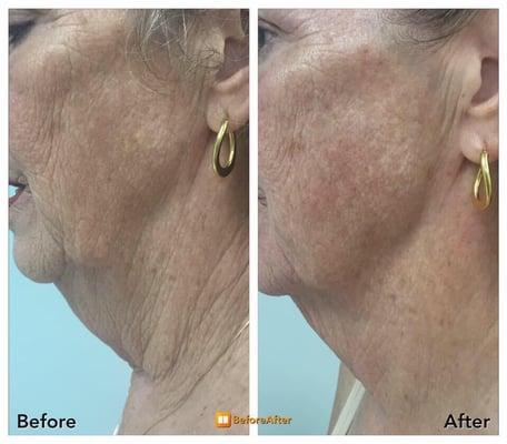 Skin tightening for face and neck