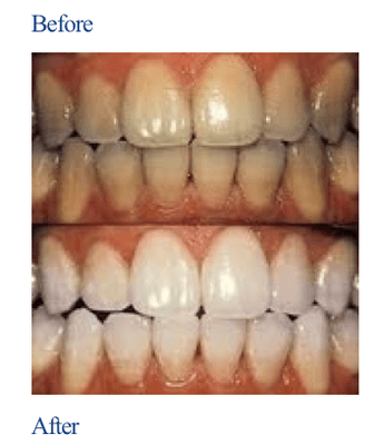 Teeth Whitening, before and after