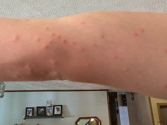 Bed bug bites on arm!