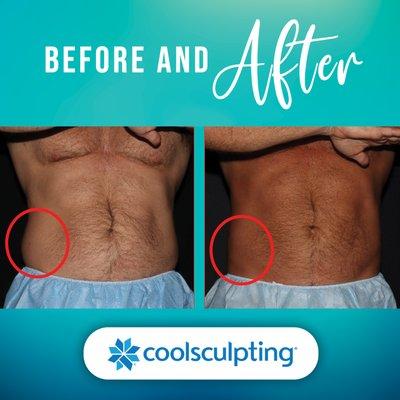 Get rid of excess fat in your flanks with CoolSculpting Elite at Bodenvy Tulsa!