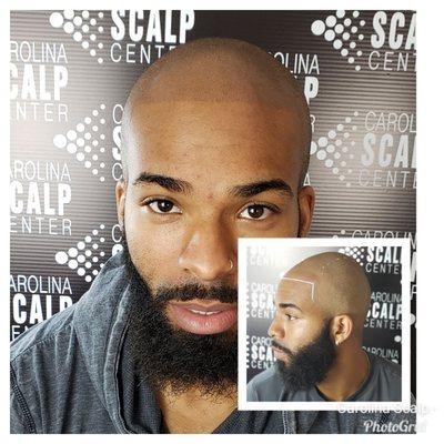 Scalp Micropigmentation gave this young man his youthful appearance back.