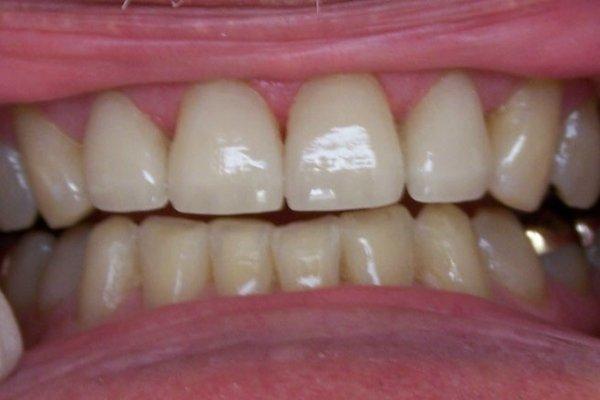 Porcelain Veneers to Restore Fractured Upper Teeth.