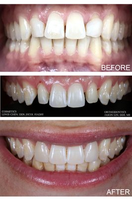 Orthodontics & Veneers