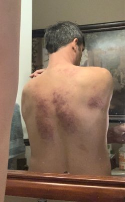 Broken blood vessel's in my back from the terrible massage technique she used.