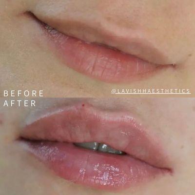 1ml Juvederm