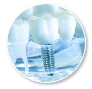 What Are Dental Implants? A healthy smile plays a vital role in the way you look and feel, but millions of people are affecte...