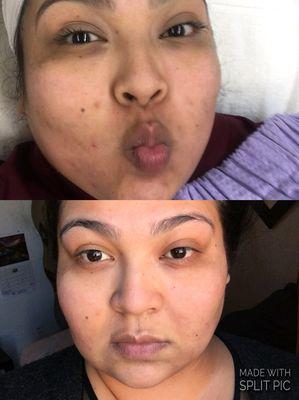 Before/after microneedling