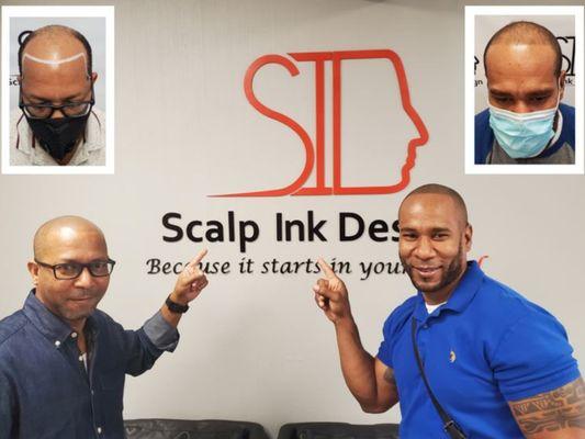 smp for men - hide balding problems with scalp micropigmentation