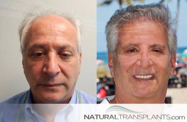 Natural Transplants, Hair Restoration Clinic