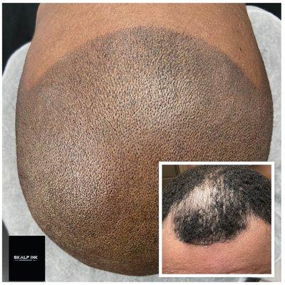 Hairline Restoration with SMP