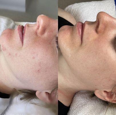 Microneedling facial results are 3 sessions