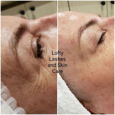 Powerful age defying facial to diminish fine lines and wrinkles.